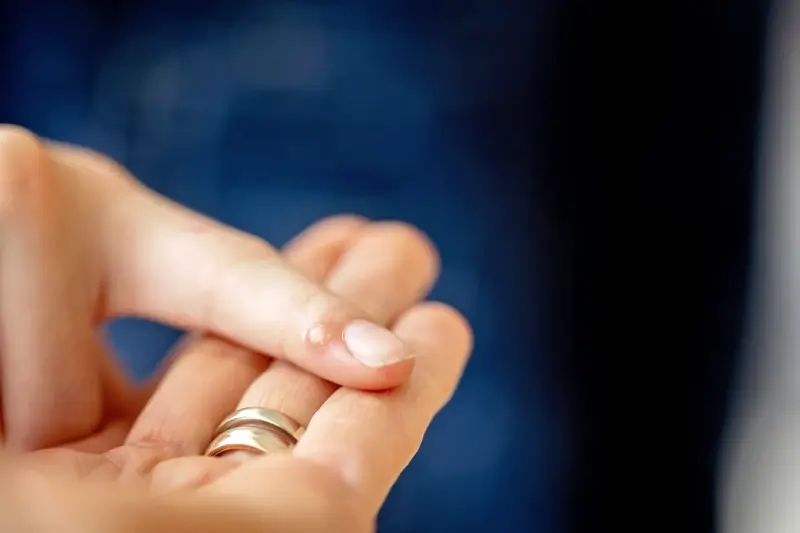 Czy po wymrażaniu kurzajki można iść na basen?